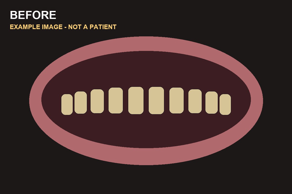 Example illustration of teeth before whitening